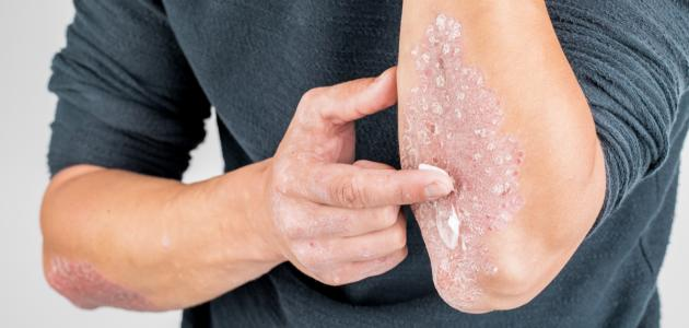 الأكثر عرضة للإصابة بأمراض المناعة الذاتية