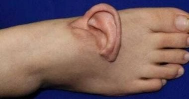 امرأة صينية تعيد تثبيت أذنها بعد 5 أشهر من زرعتها في باطن قدمها