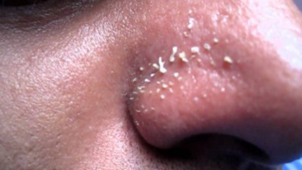 أسباب الرؤوس البيضاء في الوجه وطرق علاجها بسرعة