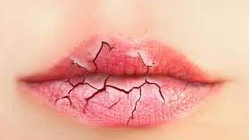 تشقق الشفاه في الشتاء: أسباب شائعة ونصائح للوقاية والعلاج