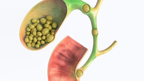 5 أعراض لا تتجاهلها تدل على مشكلة في المرارة