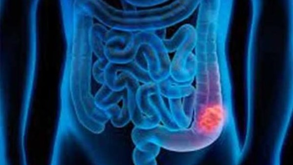 علامات مبكرة لسرطان القولون والمستقيم: ما تحتاج معرفته؟