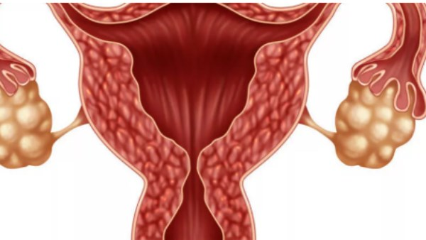 4 توابل فعالة لعلاج متلازمة تكيس المبايض أبرزها القرفة والكركم
