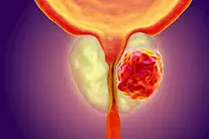 تأثير النوم على صحة البروستاتا: ما تحتاج معرفته