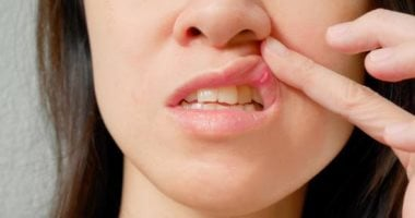 قرح الفم قد تكون علامة صحية خفية.. اعرف طرق الوقاية