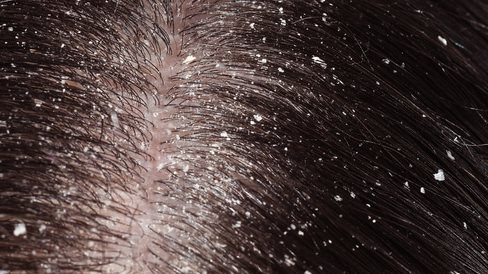 زيت للشعر يعيد النمو بعد الكيماوي ويعالج القشرة فاق التوقعات