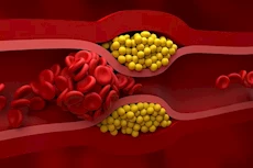 القاتل الصامت في الصباح: 4 عادات ترفع الكوليسترول بلا شعور
