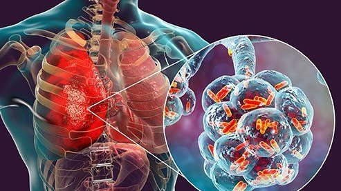الالتهاب الرئوي عند الأطفال: أمور يجب معرفتها