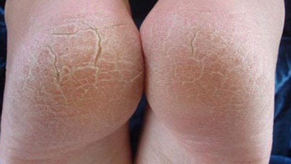 الغدة الدرقية من أبرز عوامل تشقق الكعب