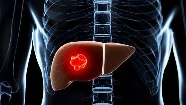 تحذير: 9 أشياء ترفع خطر سرطان الكبد وطرق الوقاية