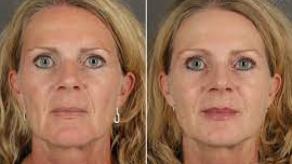 ستبدين أصغر 15 عامًا مع منتجات لعلاج التجاعيد والخطوط التعبيرية