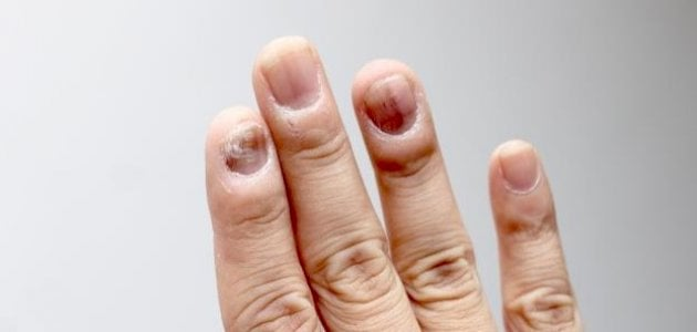 علامات الأظافر تكشف عن مشاكل صحية قد لا تعرفينها
