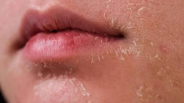 البشرة الجافة: كل ما تحتاج معرفته وعلاجها