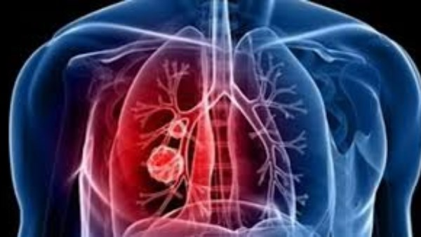 الصداع والتعب وتساقط الشعر: إنذار مبكر من مرض خطير