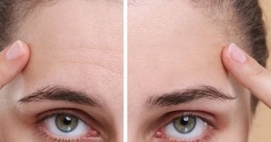 وصفات طبيعية للتخلص من تجاعيد الجبهة وعلامات العبوس
