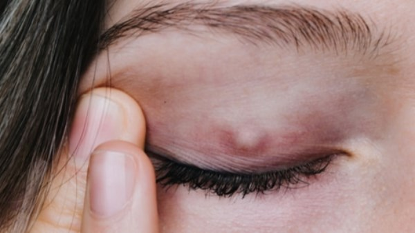 دمل العين: أعراض شائعة ونصائح لتخفيف الألم