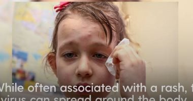 كيف ينتشر مرض الحصبة وما أعراضه وهل يسبب مضاعفات خطيرة؟