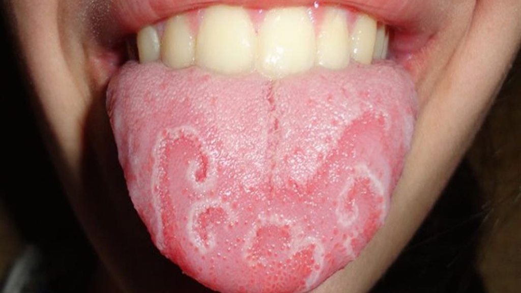 علامة في لسانك قد تكون الإنذار الأول لمرض خطير