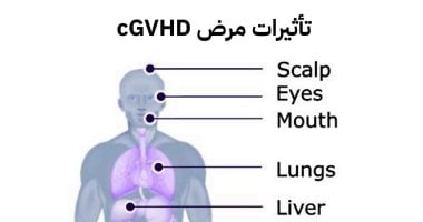 التعافي بعد زراعة النخاع العظمي