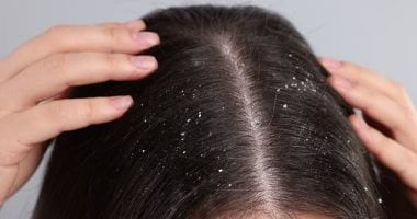 وصفات طبيعية لعلاج قشرة الرأس وتخفيف الحكة والإحراج