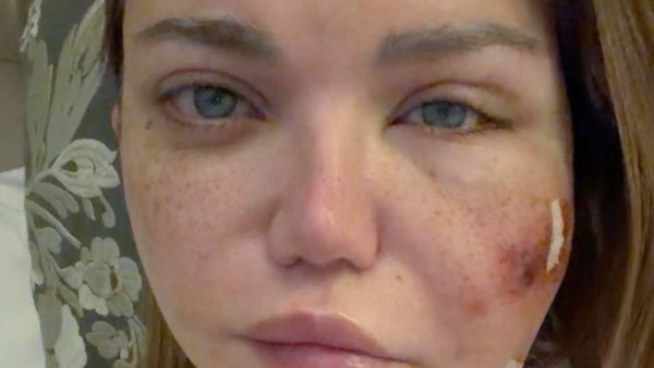 خراجات الوجه: أسباب وأعراض