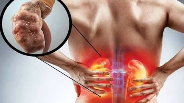 تعرف على تطور أمراض الكلى المزمنة وأهم مراحلها ونصائح للسيطرة