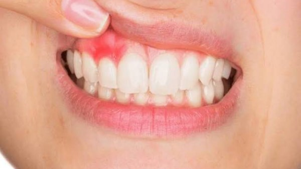 علاج التهاب اللثة: أفضل الطرق