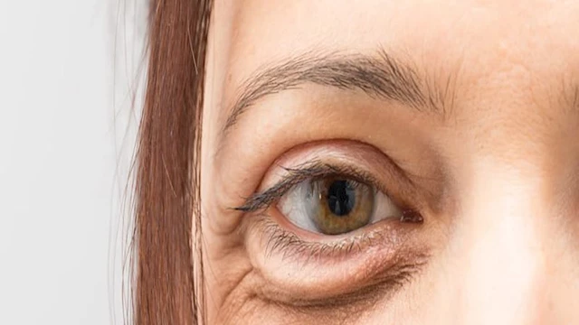 هل انتفاخ الجفون صباحاً مؤشر على مشاكل الكلى؟