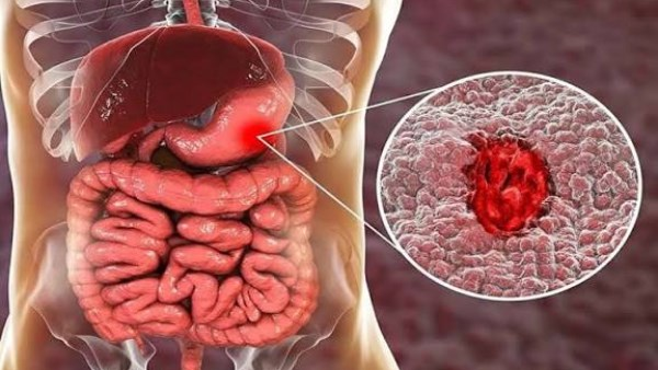 تأثير صيام رمضان على القولون