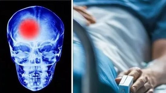 احذر: هذه العوامل تسبب جلطة الدماغ