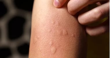 حكة الجلد: 4 علاجات طبيعية سهلة