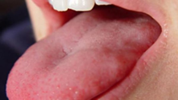 علامة في اللسان تكشف نقص الحديد و7 أطعمة يحتاجها الجسم فورا