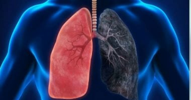 الالتهاب الرئوي الحاد: كيف يهاجم الرئتين