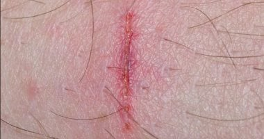 ضمادة ذكية لعلاج الجروح تطلق مضادات حيوية عند وجود بكتيريا ضارة